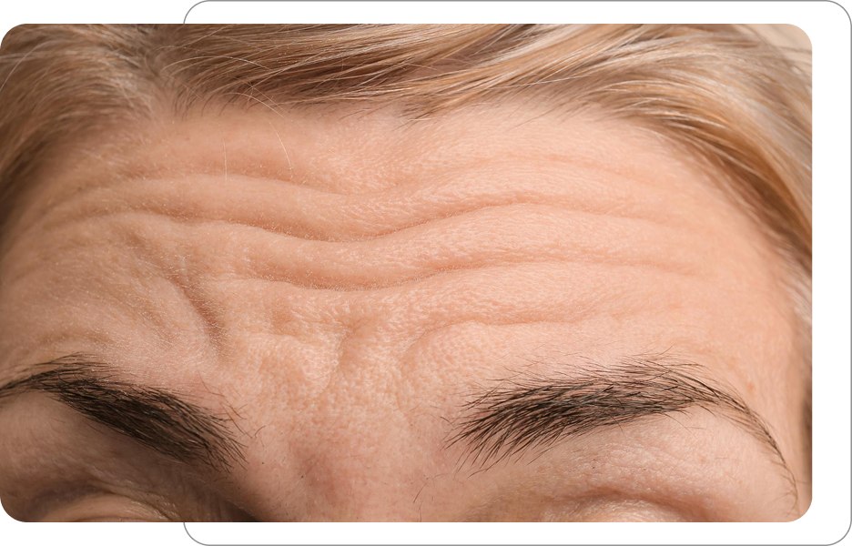 Zbliżenie na czoło osoby z widocznymi zmarszczkami poziomymi oraz strukturą skóry przed zabiegami odmładzającymi.