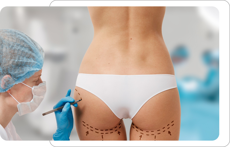Specjalista w rękawiczkach i czepku medycznym zaznacza obszary zabiegowe na udach i pośladkach pacjentki przed procedurą modelującą sylwetkę.