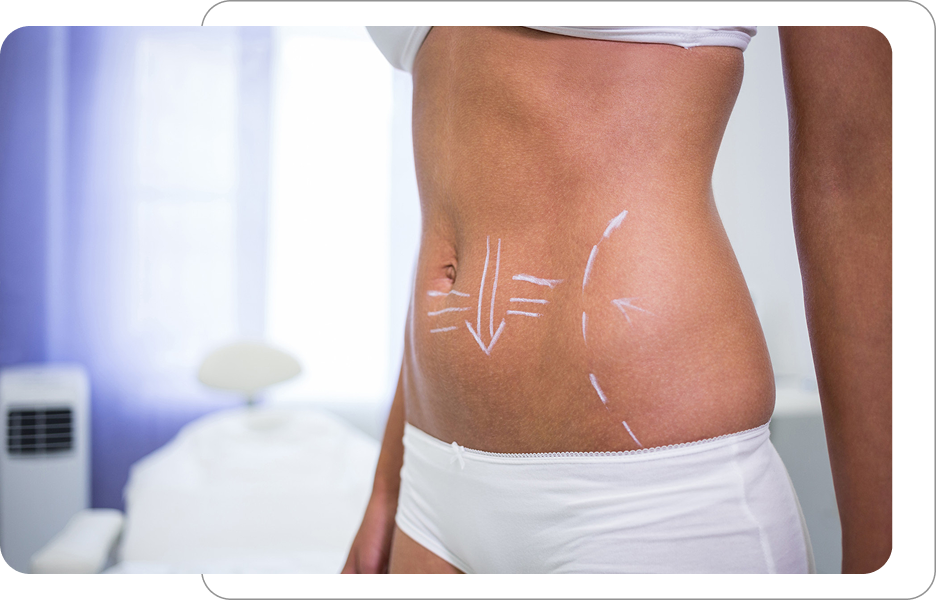 Oznaczenia zabiegowe na brzuchu kobiety przed modelowaniem sylwetki lub liposukcją w klinice medycyny estetycznej.