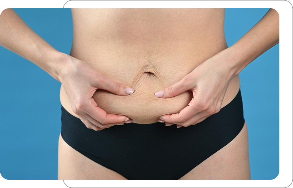 Kobieta trzymająca fałd skóry na brzuchu, obraz wskazujący utratę jędrności i możliwość wykonania zabiegów ujędrniających lub redukujących wiotkość skóry.